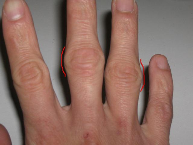 Как да се лекува народна лекарства възпаление на ставите на пръстите